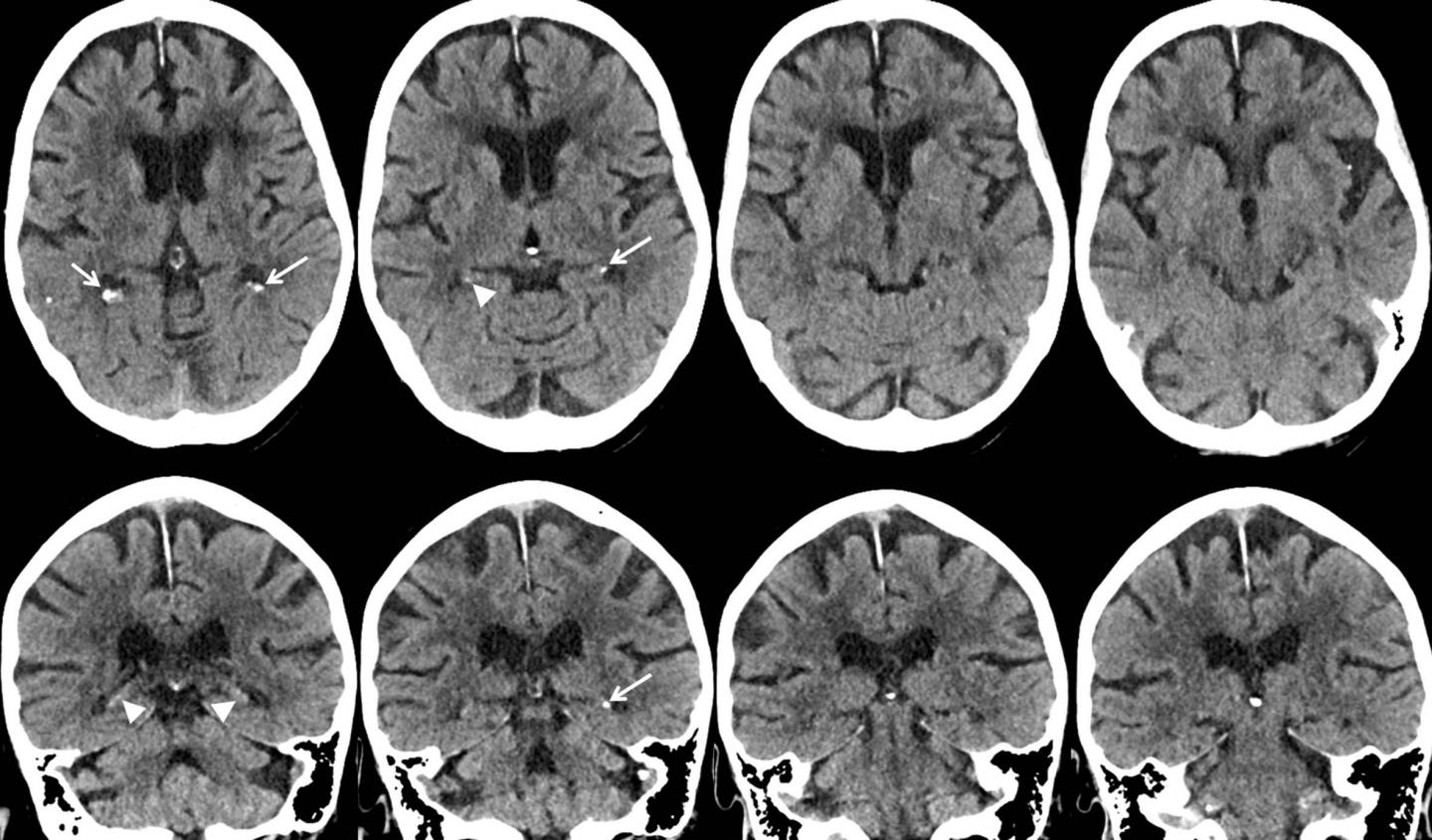 Axial and Coronal CT Images in 88-Year-Old Woman Show Mild Hippocampal Calcification