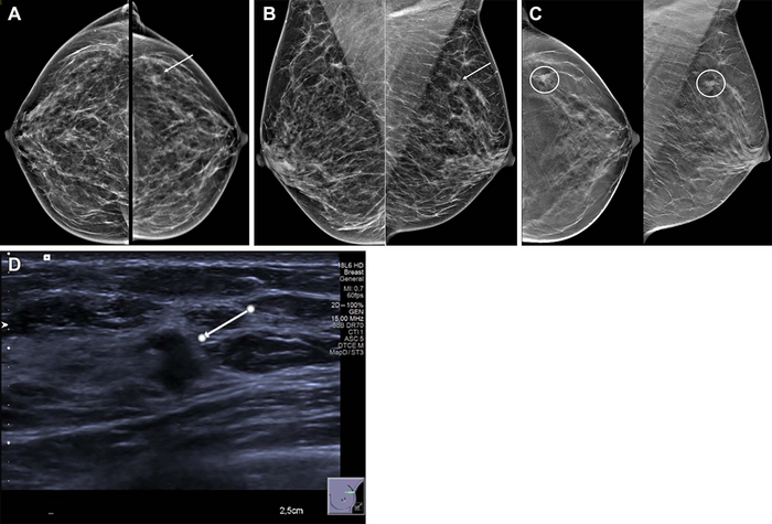 Ultrasound Effective at Diagnosing Localized Breast Lumps, Pain