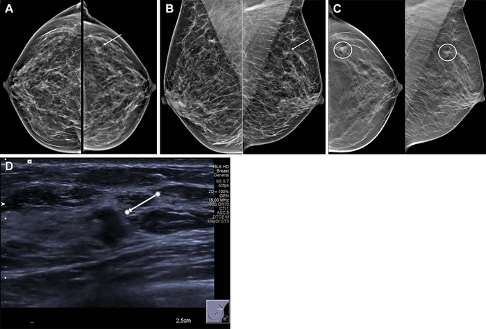 42-year woman with palpable left breast lump. (A) Standard mammogram