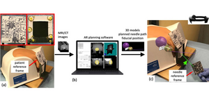 The HoloLens AR system superimposes anatomical features generated from MRI or CT scans onto the patient for real-time needle guidance in prostate interventions.