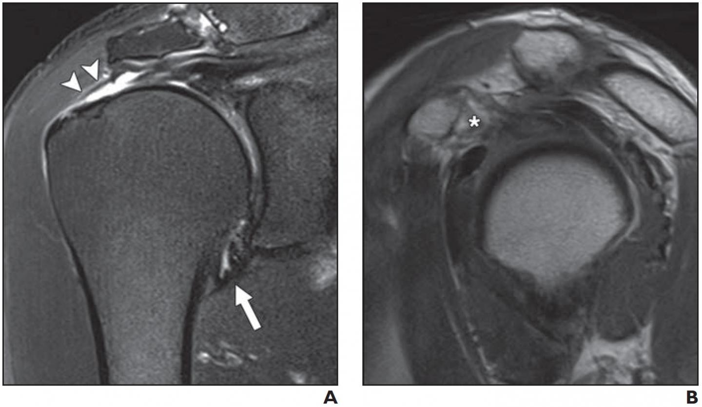 Rotator cuff tear, Radiology Reference Article