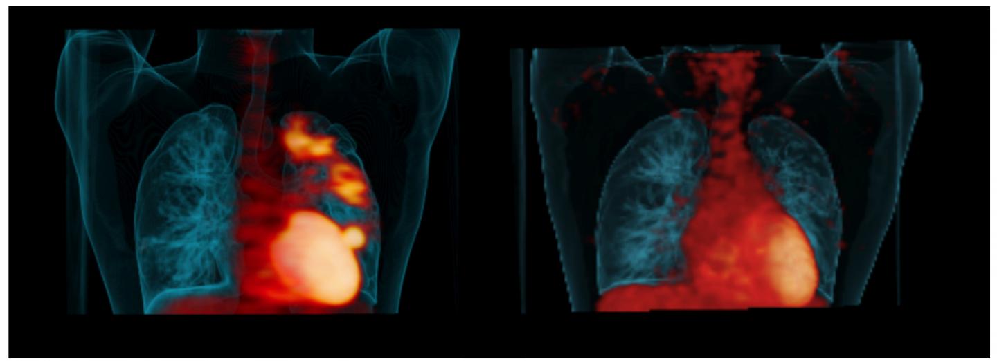 PET scans help identify effective TB drugs, s EurekAlert!