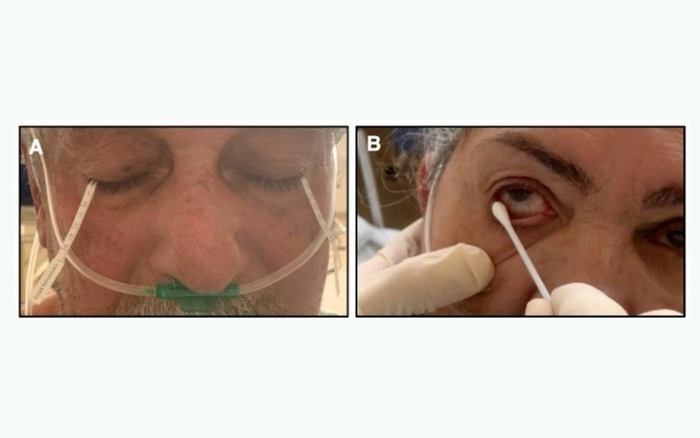 COVID-19 virus can be detected in tears sampled by ocular swab