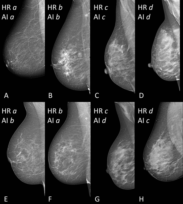 AI provides accurate breast density classific