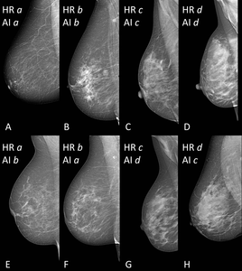 AI Provides Accurate Classification Of Breast Density BW Line   Public