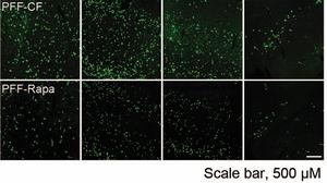 Parkinson's Disease