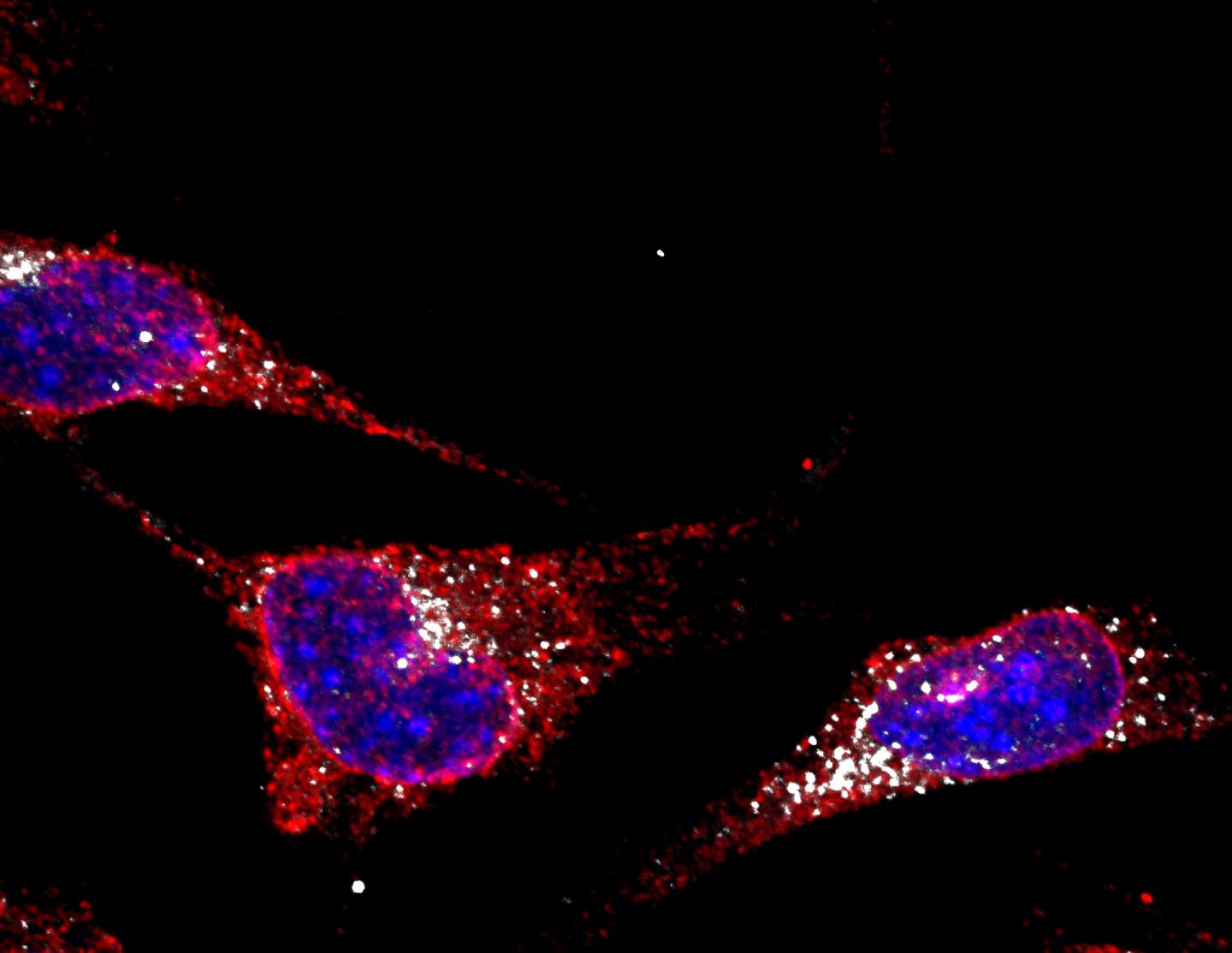 Insights from a Rare Genetic Disease May Help Treat Multiple Myeloma