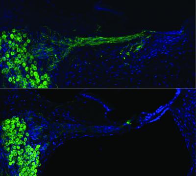 Auditory Nerves after Gene Therapy