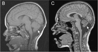 Cerebellar Atrophy