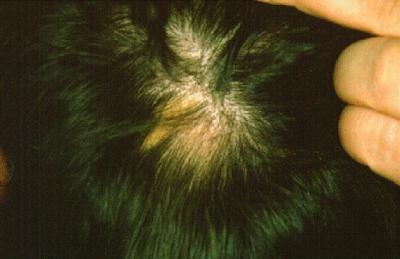 Infection Outbreaks On Teeth Can Cause Alope Eurekalert