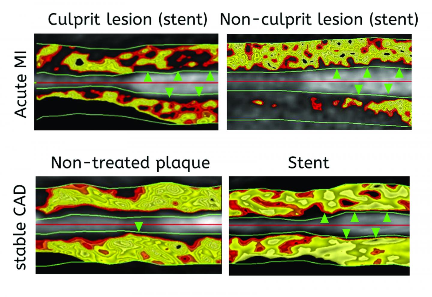 Finally, a Noninvasive Measure to Identify Dangerous Blood Vessel Plaques