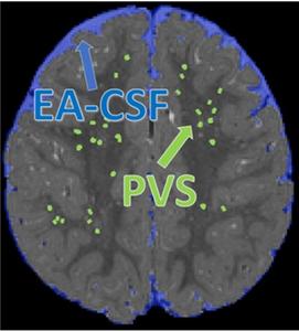 CSF MRI