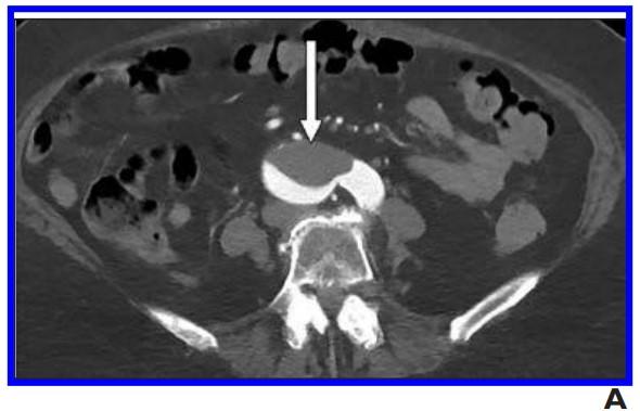 Patients With Arterial Thromboembolism Associated With COVID-19