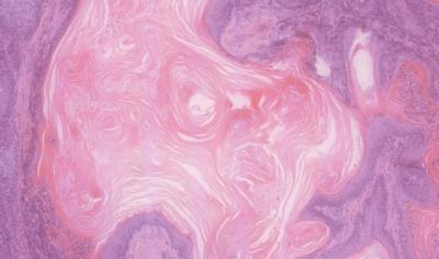 Squamous-Cell Bladder Carcinoma