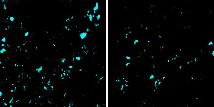 ALS Gene Therapy