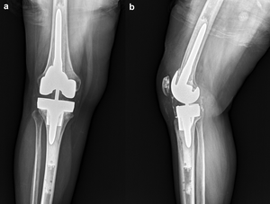 Case 1 Post-TKA