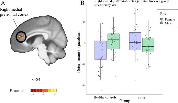 Tensor-based morphometry analysis of a T1-weighted MRI scan and post hoc box plot