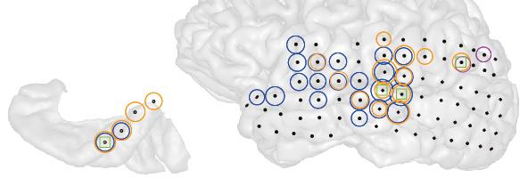 Brain Image of Patient with Tinnitus