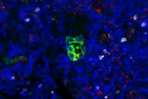 Quiescent cluster of lung adenocarcinoma tumor cells