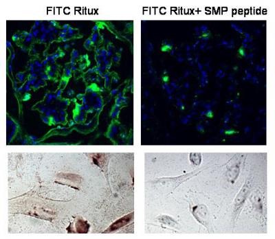 Pinpointing How Rituximab Stops Leaky Kidneys (1 of 2)