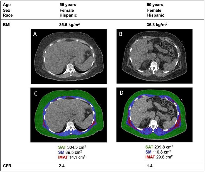 Body composition in two patients (A/C, B/D) of similar age, sex, race, and body mass index. Compared to patient (A/C), patient (B/D) has less subcutaneous fat but more intermuscular fat. CREDIT: Viviany Taqueti / European Heart Journal