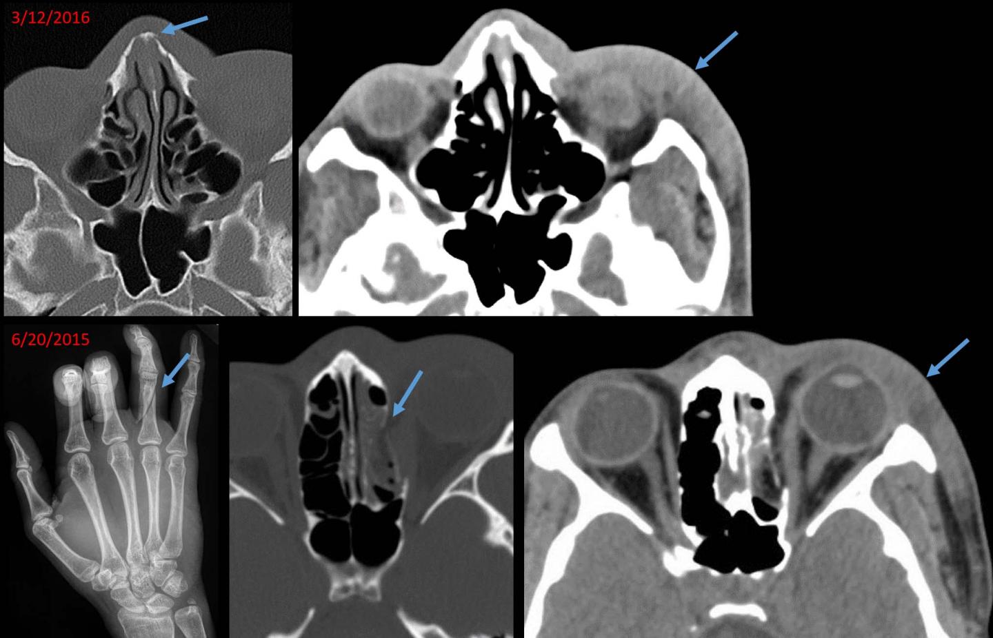 Radiology Offers Clues in Cases of Domestic Abuse and Sexual Assault