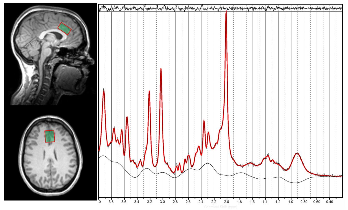 Magnetic Resonance Spectroscopy Image
