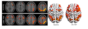 Clinical example of functional brain imaging by fMRI.