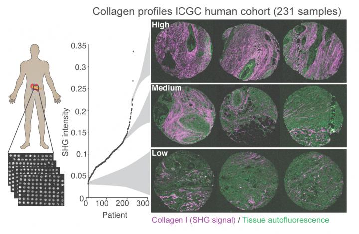 Profiling the 'Stroma' around a Tumor to Help Guide Therapy