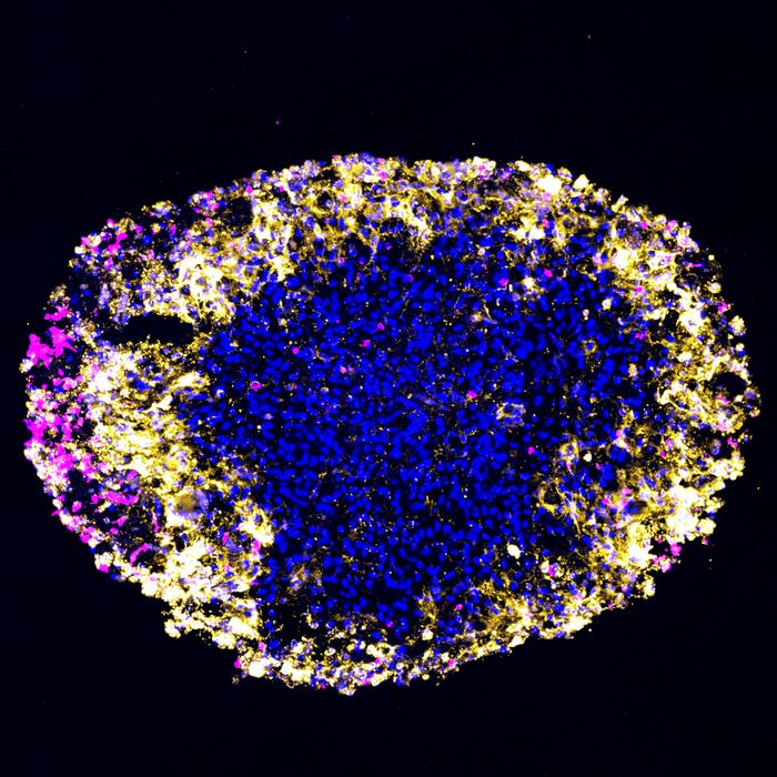 Dual-target CAR T effect on glioblastoma organoid