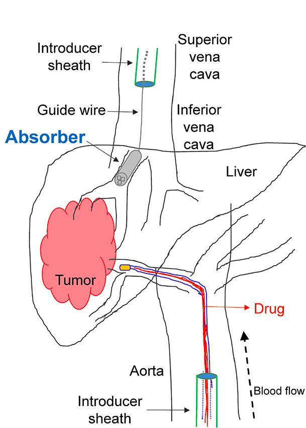 3D-Printed Absorber for Chemotherapy Drugs