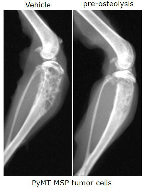 Keeping Cancer Patients' Bones Strong