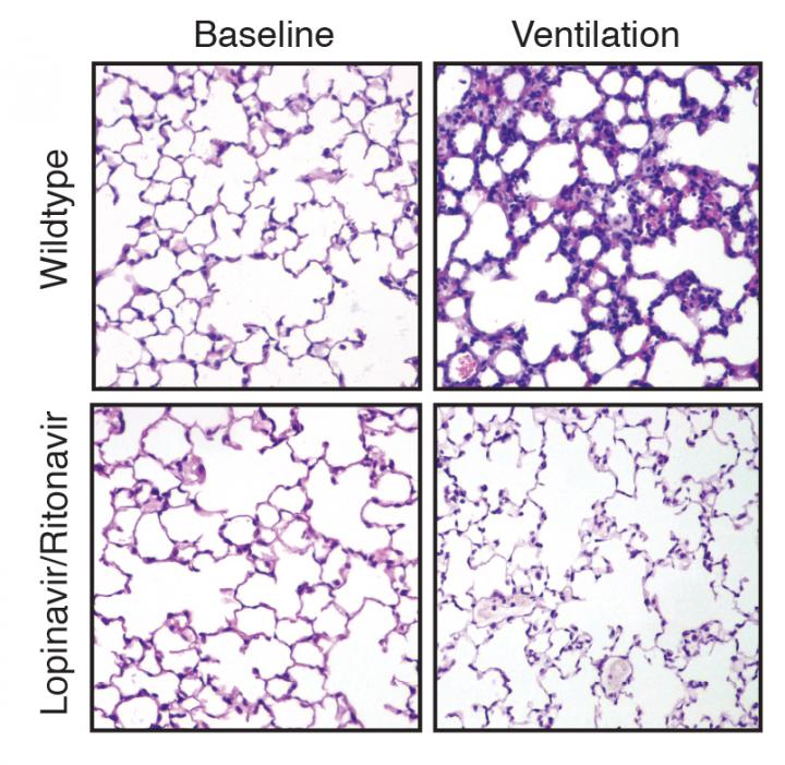 Study Unveils How Mechanical Ventilators Can Induce Lung Injury (1 of 1)