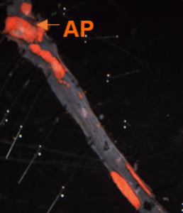 Atherosclerotic plaques