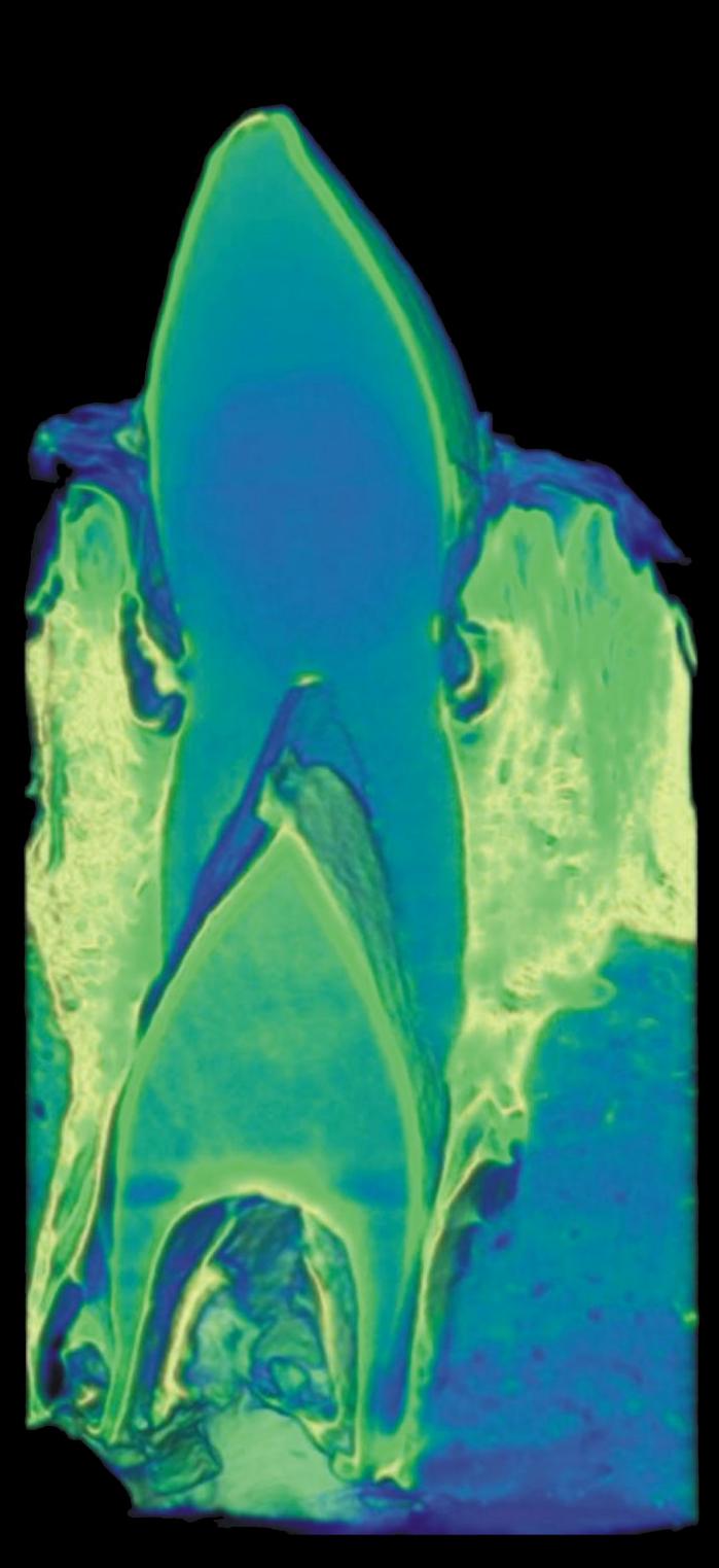 CT Scan of Tooth