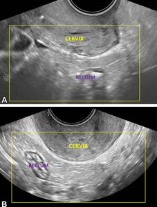 Transvaginal US images