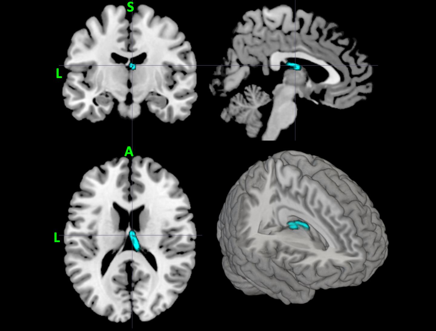 Neuroimaging Reveals Differences in Brain Activity of Those with Major Depressive Disorder