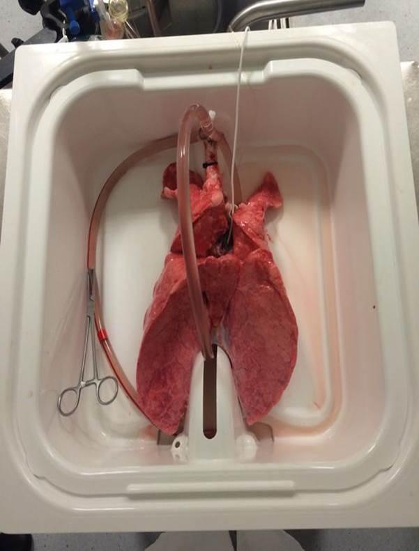 EVLP on a Lung