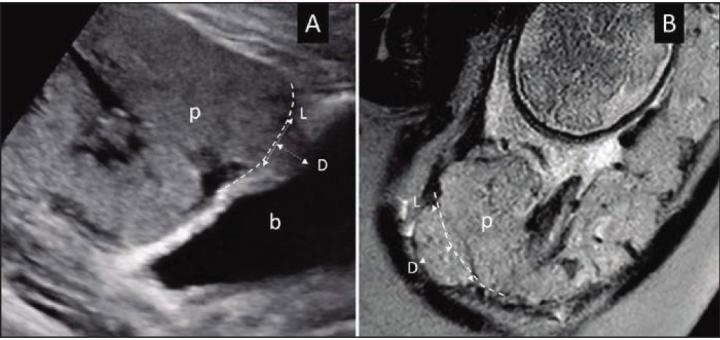 Placental Bulge Sign on Ultrasound and MRI, Respectively, in Women With Suspected Placental Accreta Spectrum Disorder