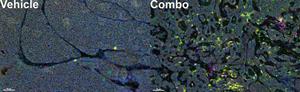 Tumor-fighting immune cells in the tumor before (left) and after (right) the novel combination therapy.