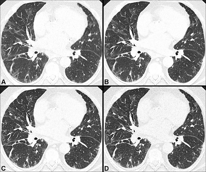 Photon-Counting CT Shows More Post-COVID-19 Lung Damage