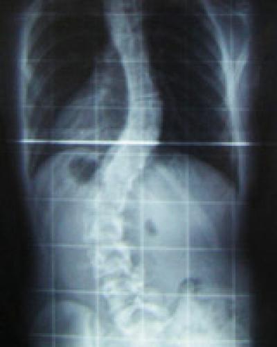 Spinal X-ray