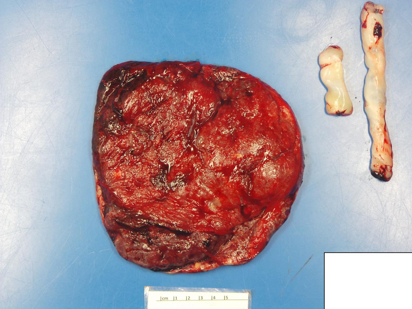 Maternal Side of a COVID-Impacted Placenta