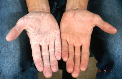 PPK Palmar Aspect After Water