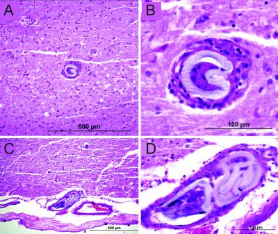 Embolic Foreign Material Found at the Site of a Brain Hemorrhage Several Days after Flow-Diversion