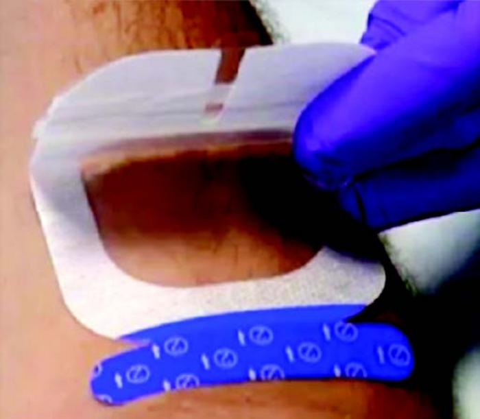 UltraDrape Minimizes UGPIV Risks - Image 1