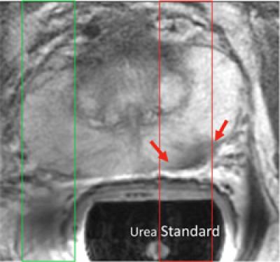First Human Data: Hyperpolarized Pyruvate Injection in Subjects with Prostate Cancer
