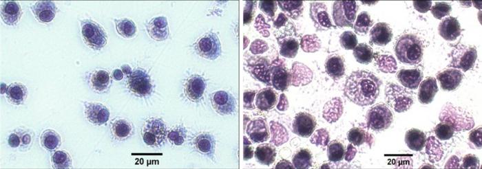 AML vs human alveolar macrophages