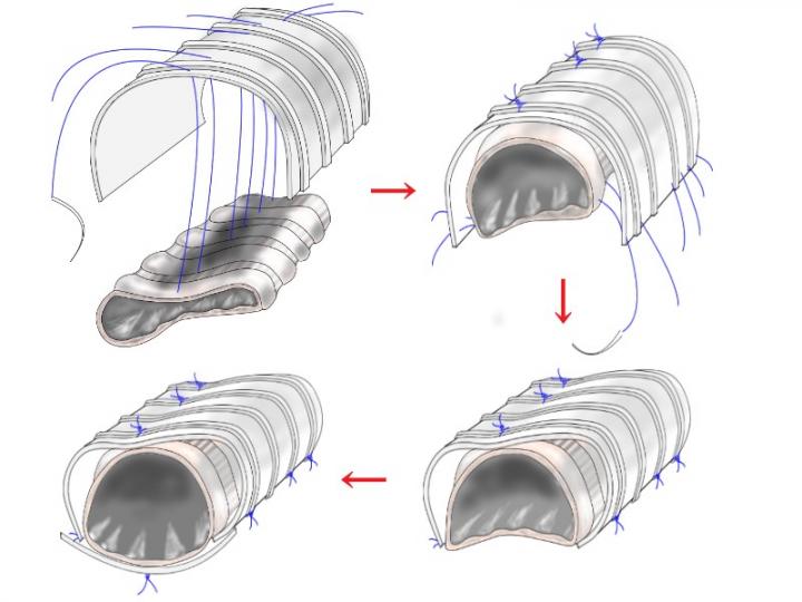 External Stenting Can Relieve Chronic Airway Obstruction in Children