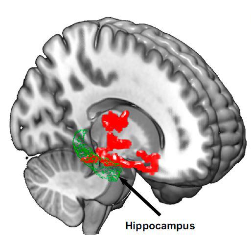 Regions of Beta-Amyloid Accumulation